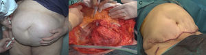 Escenario III. Hernia incisional medial asociada a una abdominoplastia. A. Mujer con eventración y cicatriz infraumbilical solamente. B. Detalle de la hernia y preparación del colgajo. C. Reparación terminada.