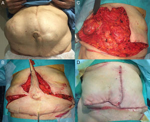 Escenario V. A. Mujer con hernia incisional medial y lateral, con 2 cicatrices de laparotomía y de la reconstrucción de un estoma. B. Abdominoplastia en ancla. C. Pared abdominal disecada con los defectos medial e ilíaco. D. Imagen de la reconstrucción final.