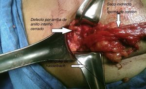 Cierre del orificio herniario.