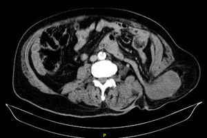 Tac abdominopélvico: herniación del meso sin presencia aparente de asas y con hematoma asociado a través de la pared abdominal posteroinferior izquierda (hernia de Petit).