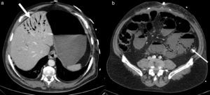 (a) Isquemia intestinal con aire portomesentérico (flecha gruesa). (b) Asas intestinales con paredes adelgazadas que no captan contraste y con neumatosis (flecha).