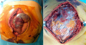 (a) Placas de necrosis intestinal. (b) Bolsa de Bogotá.
