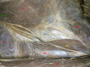 Trayecto de los nervios abdominogenitales en el espacio preperitoneal (lado derecho. AG: nervios abdominogenitales; EIAS: espina ilíaca anterosuperior; Ih: nervio iliohipogástrico; Ii: nervio ilioinguinal; MCL: músculo cuadrado lumbar; MD: músculo diafragma; MI: músculo ilíaco; MP: músculo psoas; MT: músculo transverso; SC: nervio 12.o o subcostal).