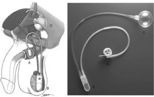 Esfínter urinario artificial AMS 800™ (imágenes obtenidas del manual AMS 800™ de American Medical Systems). A: Manguito oclusivo. B: Bomba de control. C: Balón regulador de presión.