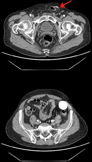 Tomografía computarizada abdominal (corte axial): Arriba: se observan los dispositivos del sistema junto al saco herniario inguinal izquierdo (flecha). Abajo: Balón-reservorio en fosa ilíaca izquierda.