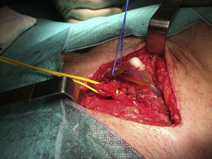 Resultado final con la aponeurosis del músculo oblicuo mayor suturada.