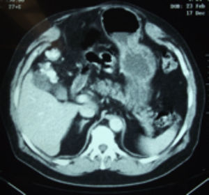 Tomografía computarizada simple de abdomen y mediciones de músculos de pared abdominal.