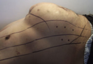 Infiltración de toxina botulínica (Botox®) un mes antes de la cirugía de plastia de pared abdominal, siguiendo el mapeo ya establecido.