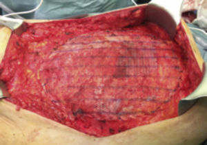 Cierre aponeurótico del defecto y fijación de la malla con sutura y si es necesario malla en posición supraaponeurótica.
