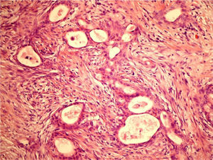 Corte histológico (40x, tinción con hematoxilina-eosina) que muestra tejido fibroso infiltrado por neoplasia que se dispone formando estructuras ductales revestidas por epitelio cúbico de citoplasma eosinófilo y núcleos vesiculosos.