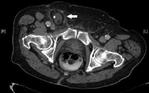Corte axial de TC en el que se identifica una hernia femoral incarcerada en la región femoral derecha con líquido libre y un apendicolito en el interior del saco herniario.