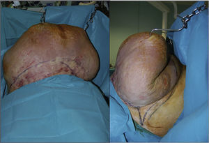 Faldón abdominal suspendido mediante «ganchos» anclados al tejido celular subcutáneo del paciente, y fijados a barra transversal unida a la mesa quirúrgica.