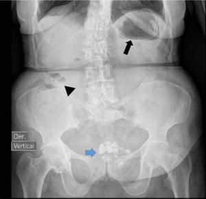 Radiografía anteroposterior de abdomen en la que se observa sonda en la cámara gástrica (flecha negra) y distribución normal del gas intestinal (punta de flecha). En la pelvis se aprecian calcificaciones inespecíficas (flecha azul).