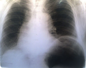 Radiografía de tórax con neumoperitoneo preoperatorio.