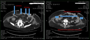 Evaluación del defecto parietal por tomografía axial computarizada.
