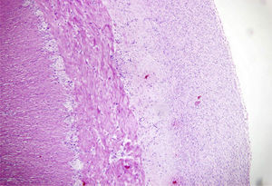 Histopathology, hematoxylin and eosin stain: serous membrane of the intestine with a fibrous band obliterating the lumen.