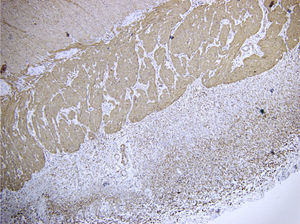 Histopathology, immunohistochemistry: a more evident fibrous band is observed that is strictured and completely compresses the lumen of the distal ileum.