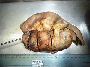 Surgical specimen of the solitary fibrous tumor confined to the mesentery of the ileum.