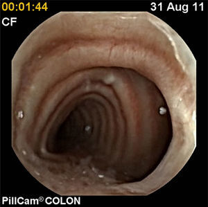 The capsule endoscope entering into the respiratory tract, showing the tracheal rings.
