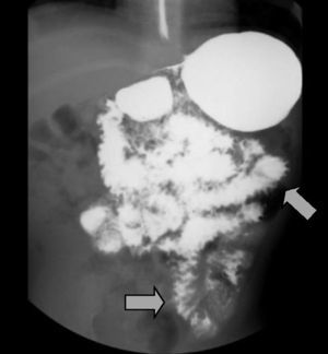 Intestinal transit showing the thickening of the folds in the small bowel with spiculated edges and «stack of coins» image.