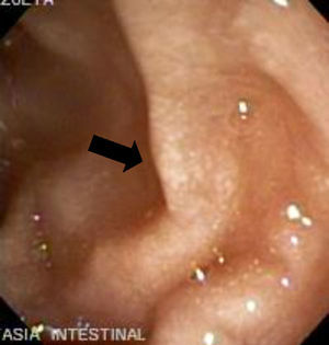Gastroduodenal endoscopy with white frost, consistent with intestinal lymphangiectasia.