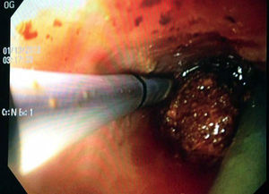 Intraoperative choledochoscopy. The image shows a stone located in the confluence of the biliary tract, as well as the blue endoprosthesis that was palliatively placed during the ERCP. The laparoscopic grasper with which the stone was extracted can also be seen. ERCP: endoscopic retrograde cholangiopancreatography.