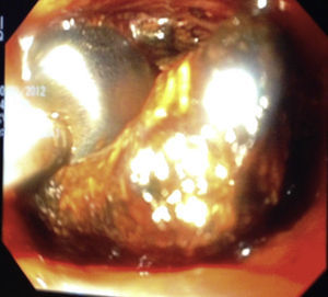 View of an intraoperative choledochoscopy with active extraction of a large stone located in the confluence and the left hepatic duct, through an endoscopic balloon.