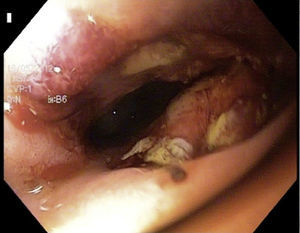 Immediate postoperative peroral choledochoscopy, showing the recently formed choledochoduodenal anastomosis; the biliary tract can be seen inside at the back.