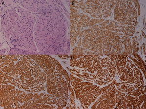 A) Neoplastic proliferation made up of short fascicles of fusiform cells, without atypia (H&E x20). B) Immunohistochemical positivity for smooth muscle markers (x20). C) Positivity for desmin (x20). D) Positivity for H-caldesmon (x20).