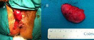 A) Surgical removal of the anorectal tumor that does not appear to have a solution of continuity with the sphincteric fibers. B) Smooth surface oval-shaped tumor.