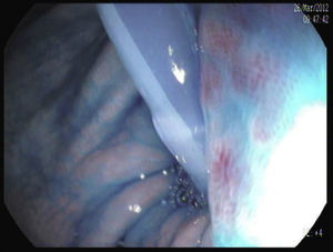 The catheter crosses the pylorus migrating into the duodenum.