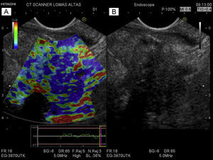 A) The elastographic image of adenocarcinoma of the neck of the pancreas. The blue area seen in the center corresponds to the tumor (rigid tissue), the site where the FNAB was performed. Normal (soft) pancreatic tissue surrounds the tumor. B) The EUS mode-B image of a hypoechoic, heterogeneous lesion with irregular edges in the neck of the pancreas that corresponds to adenocarcinoma of the pancreas in the pancreatic neck. It is not possible to differentiate the tumor from the surrounding normal pancreatic tissue.