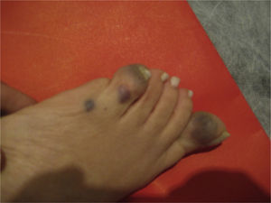 Rounded bluish lesions deforming a foot.