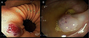 Endoscopic lesions. A) The image of a rounded, bluish, soft and depressible lesion measuring 2cm in diameter on the anterior surface of the antrum. B) Similar lesions on the colon.