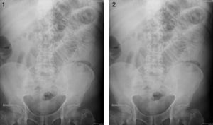 Plain x-ray images showing small bowel obstruction data.