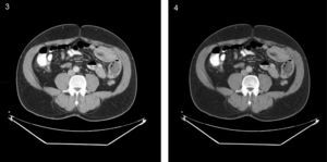 Computed axial tomography images in which the segment involved in the intussusception can be seen.