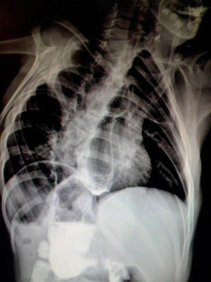 Chest and abdominal X-ray showing the characteristic data of the VACTERL association.