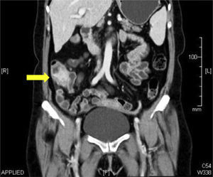 Abdominal tomography scan using contrast medium showing a tumor, 5cm in diameter, at the level of the cecum, with thickening of the wall in the terminal ileum and the cecum; adenopathies are also identified.