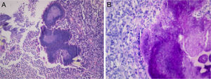 A) Abscess with acute and chronic inflammation in which sulfur granules are observed. B) Magnification of the granules in which the radiated filaments are seen.