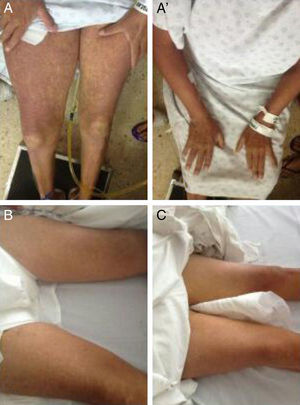 Cutaneous lesions characteristic of DRESS. A, A’) Upon admission. B) Progression after 4 days of treatment. C) Day 6 of treatment.