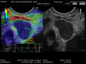 Qualitative EUS-EG of the paraesophageal lymph node. A lymph node that is > 1cm, oval, hypoechoic, and with well-defined margins can be observed in the gray-scale image in the right window. The same image is shown in the left window, but with superimposed elastography that shows the homogeneous blue pattern (type 3). The strain graph with a yellow rectangle from the frame average option can be seen.