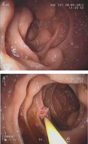 Upper gastrointestinal endoscopy showing numerous raised lesions in the bulb and second portion of the duodenum consistent with pneumatosis cystoides intestinalis.