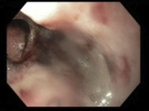 Esophageal perforation.