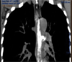 The chest computed tomography scan with contrast medium showing pneumomediastinum and contrast material leakage at the left lateral surface of the esophagus.