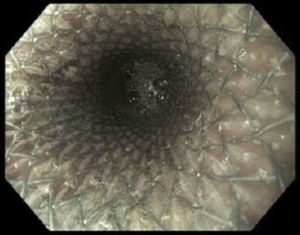 The fully covered esophageal metal stent occluding the entire perforation.