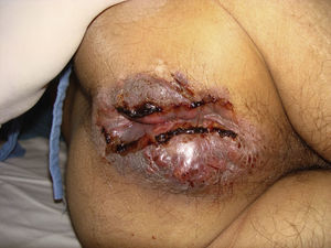 Anal tumor upon admission to the emergency department.