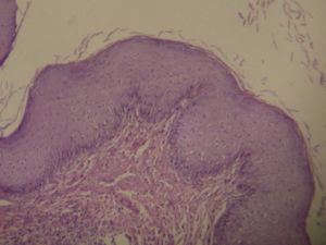 Histopathologic slide of the anal tumor.