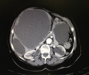 Abdominal computed tomography scan showing voluminous hepatic cysts.