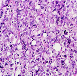 H&E stain; adenocarcinoma with signet ring cells.