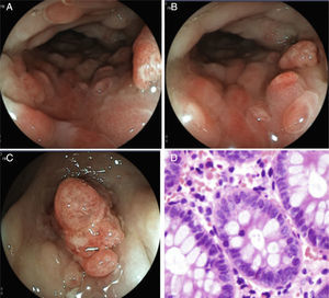 A and B) the descending colon showing the inflammatory changes, edema of the mucosa, patchy erythema, pseudopolypoid formations, and vascular pattern loss. C) Lesion with a polypoid aspect in the sigmoid colon with loss of mucosal continuity, edema, and vasculature alteration. D) Photomicrography shows abundant eosinophils in the lamina propria, up to 70 per field at a high magnification.
